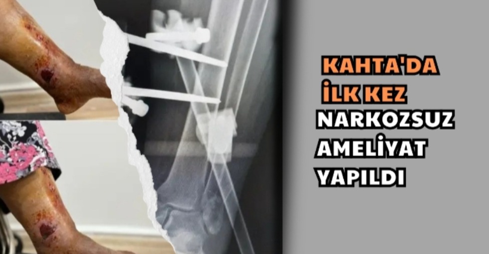 KAHTA'DA İLK KEZ NARKOZSUZ AMELİYAT YAPILDI 